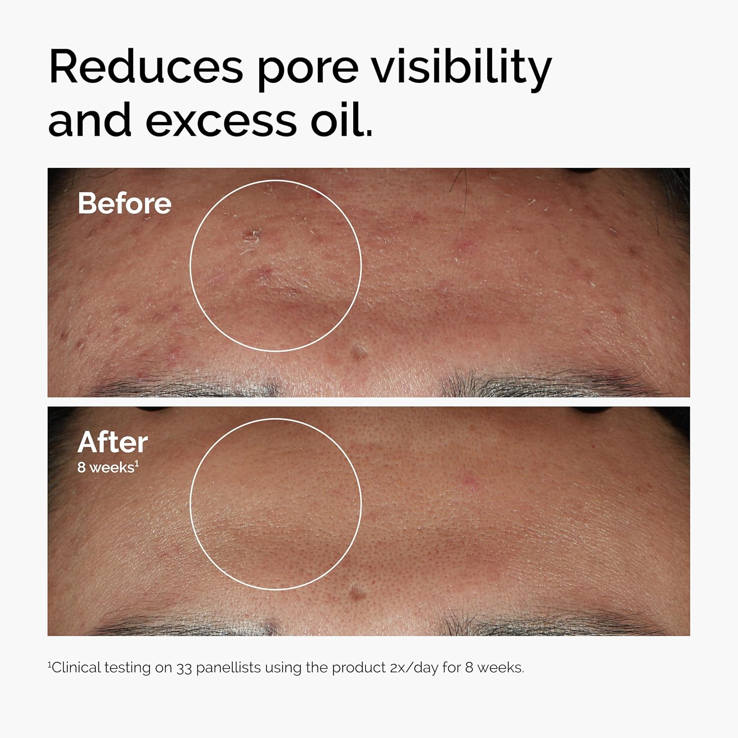 The Ordinary Niacinamide 10% + Zinc 1%, 30 ml